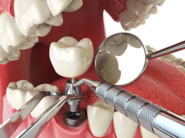 Best Emergency Tooth Extraction in USA